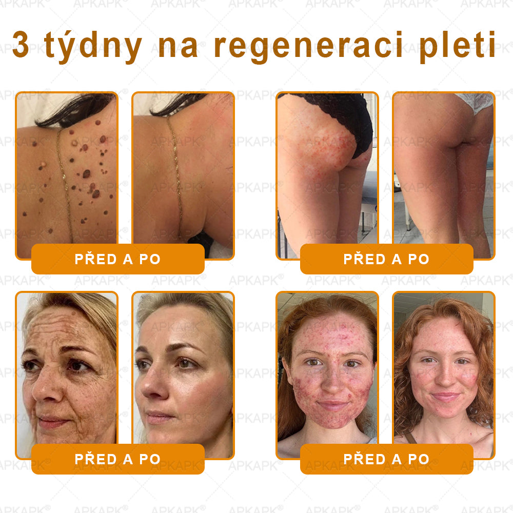 𝖠𝖯𝖪𝖠𝖯𝖪® 🐝 Krém s včelím jedem na obnovu pokožky 🐝 pomáhá při řešení kožních problémů, jako jsou: vrásky, jizvy, pigmentové skvrny, strie, akné, lupénka, ekzém, kožní léze, podráždění, záněty a další kožní potíže.